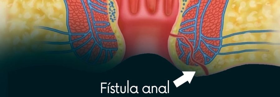 fístula anal