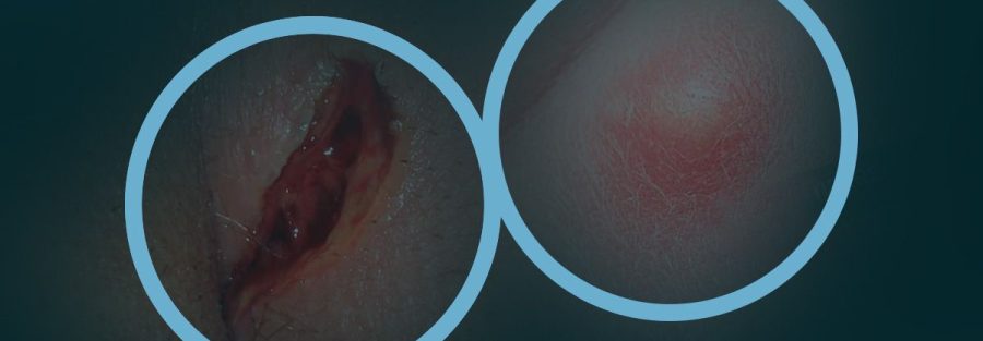 fístula anal