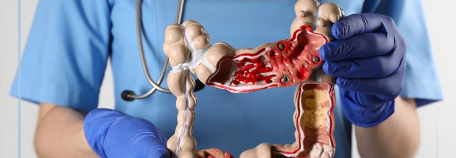 câncer de intestino