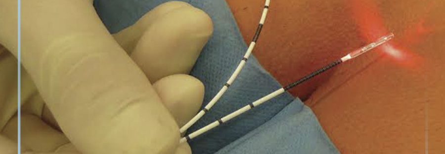 cisto pilonidal