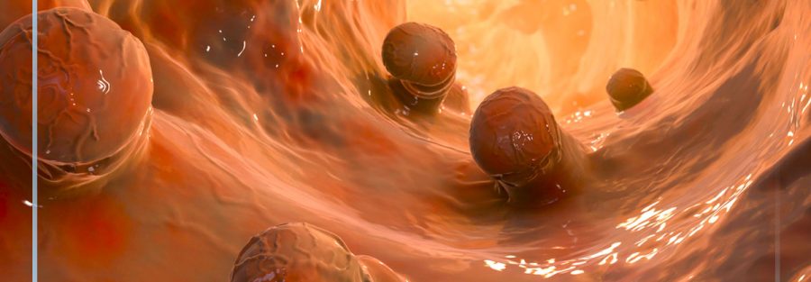 câncer de intestino