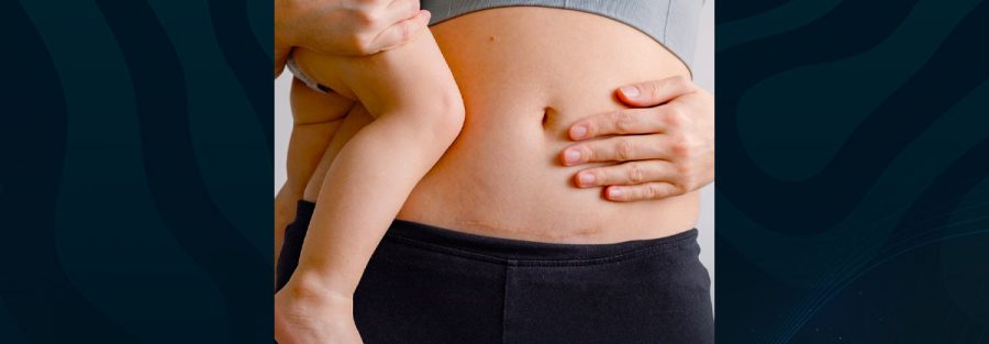 Diástase abdominal pós-parto