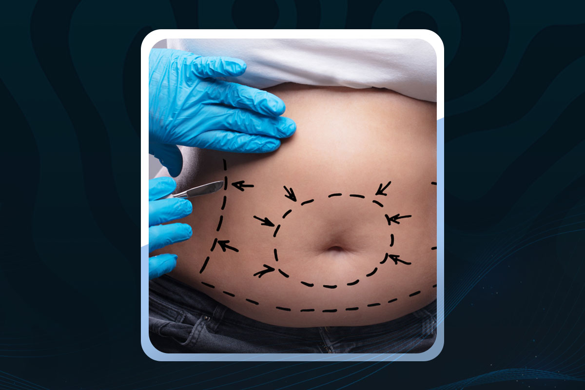 Diástase Abdominal