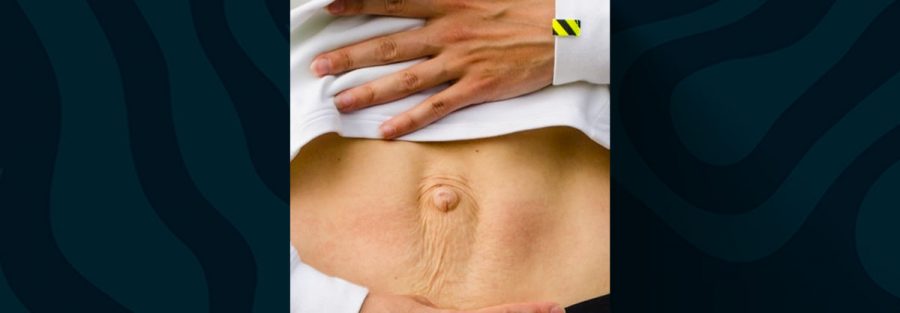 diástase abdominal